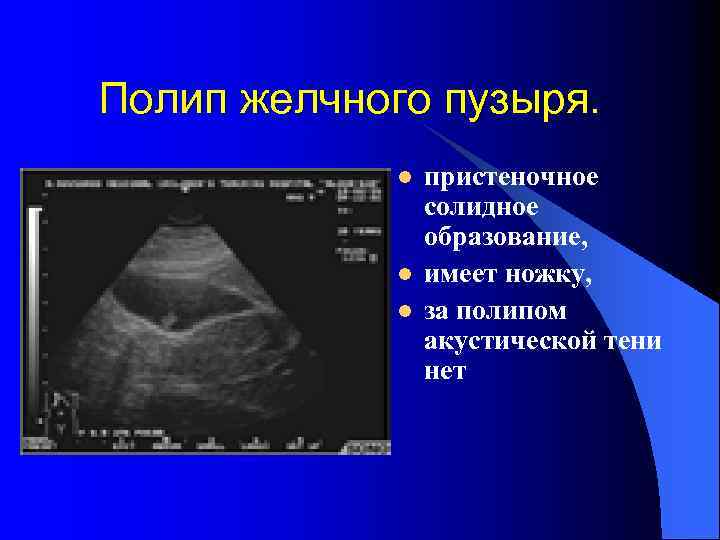 Полип желчного пузыря. l l l пристеночное солидное образование, имеет ножку, за полипом акустической