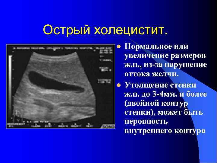 Острый холецистит. l l Нормальное или увеличение размеров ж. п. , из-за нарушение оттока