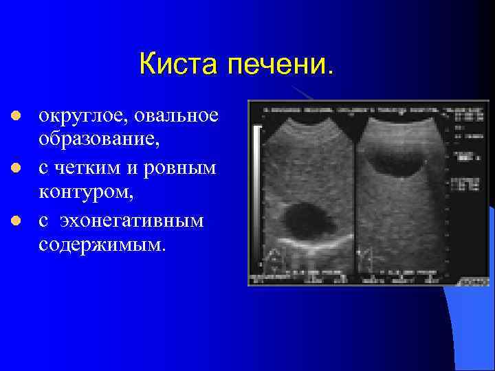 Киста печени. l l l округлое, овальное образование, с четким и ровным контуром, с