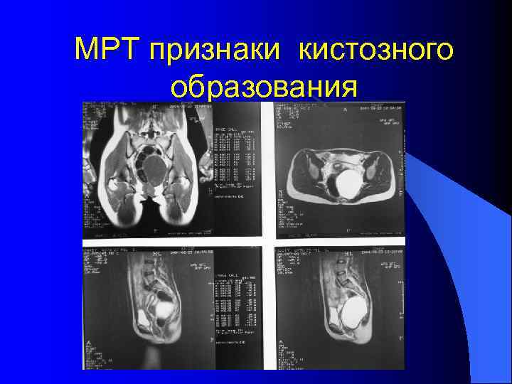 МРТ признаки кистозного образования 