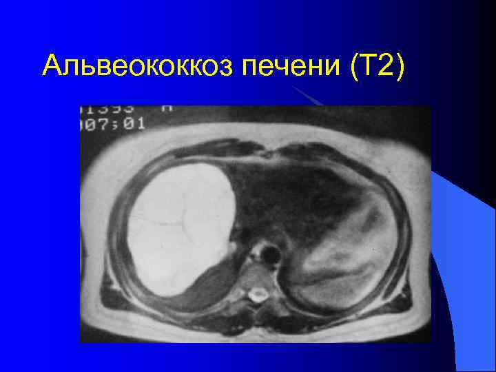 Альвеококкоз печени (Т 2) 