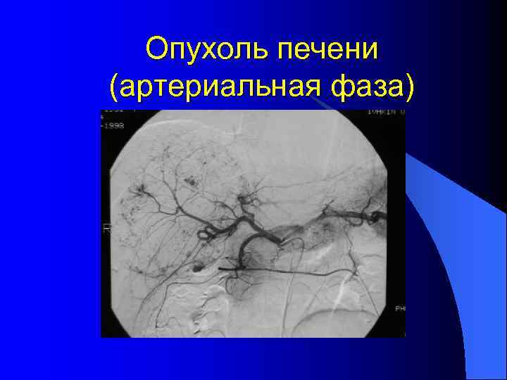 Опухоль печени (артериальная фаза) 