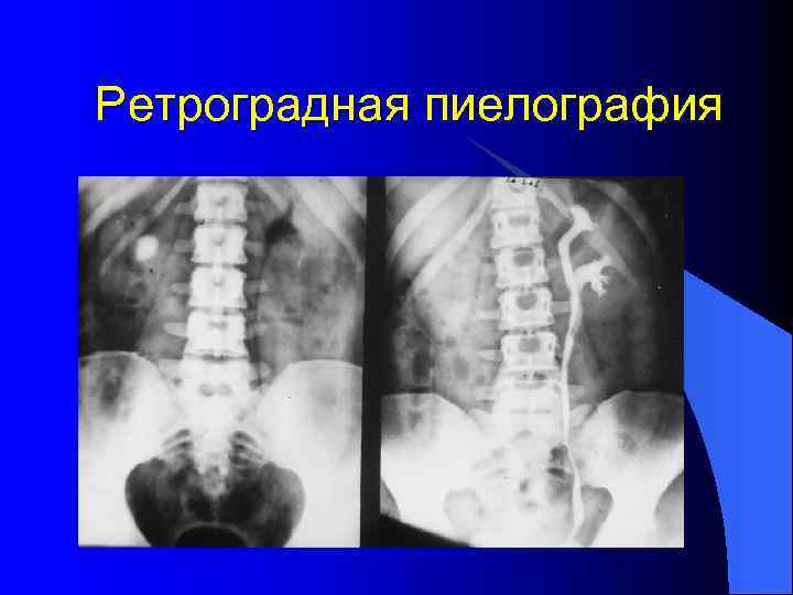 Ретроградная пиелография 