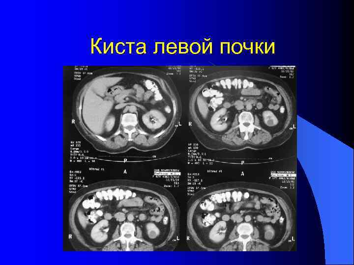 Киста левой почки 