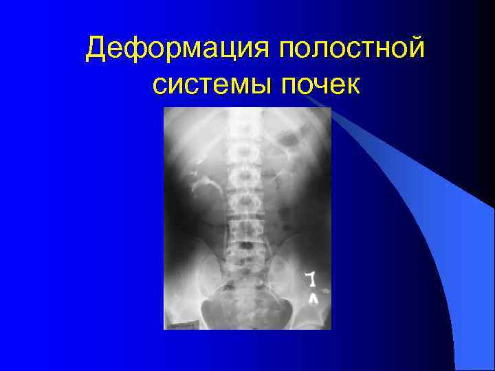 Деформация полостной системы почек 