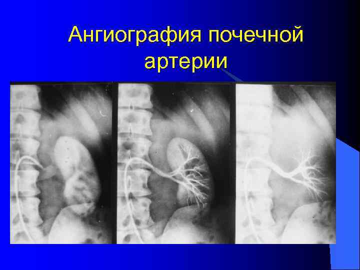 Ангиография почечной артерии 