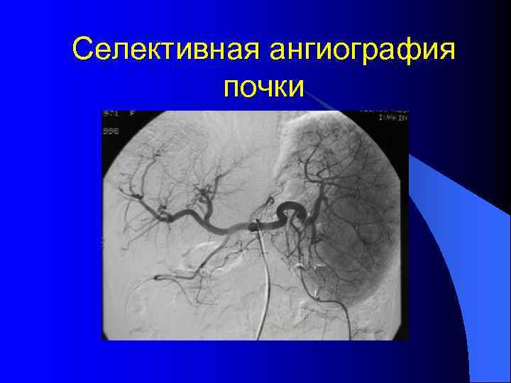 Селективная ангиография почки 