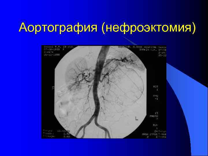 Аортография (нефроэктомия) 