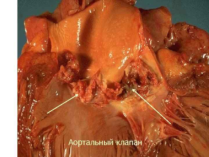  Аортальный клапан 