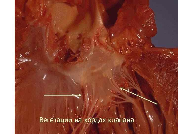  Вегетации на хордах клапана 