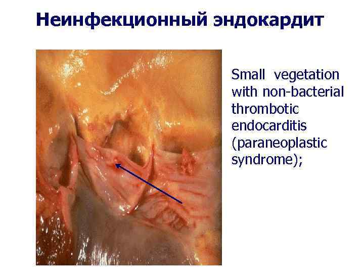 Неинфекционный эндокардит Small vegetation with non-bacterial thrombotic endocarditis (paraneoplastic syndrome); 