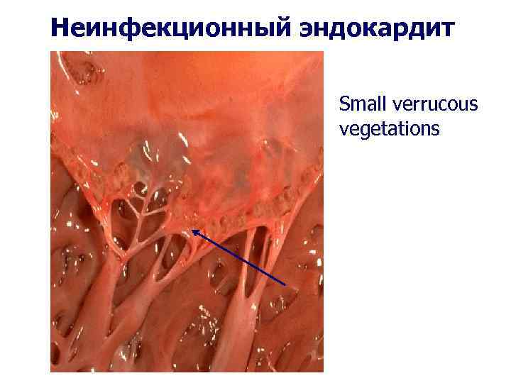 Неинфекционный эндокардит Small verrucous vegetations 