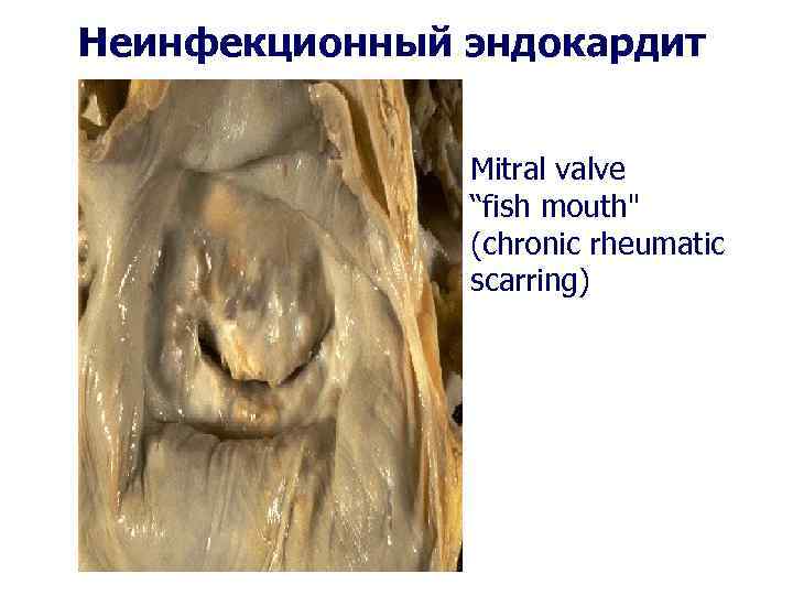 Неинфекционный эндокардит Mitral valve “fish mouth" (chronic rheumatic scarring) 