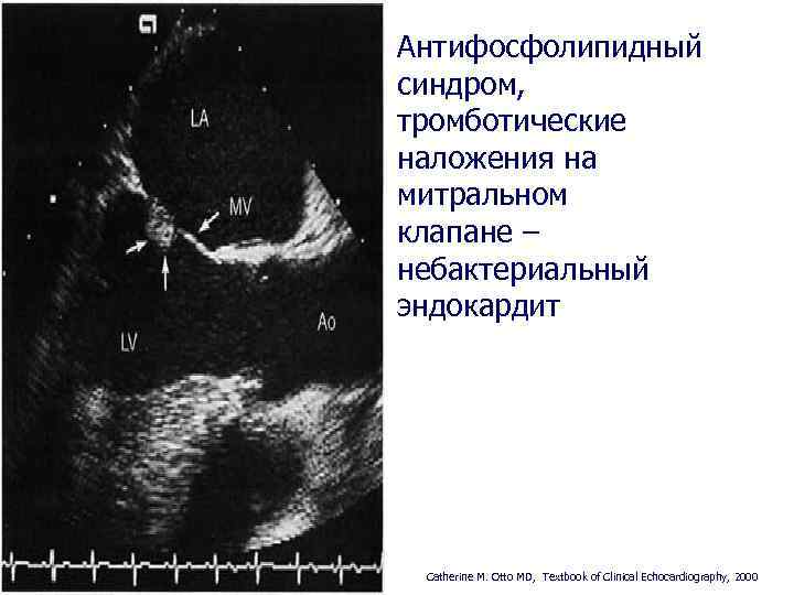 Антифосфолипидный синдром, тромботические наложения на митральном клапане – небактериальный эндокардит Catherine M. Otto MD,