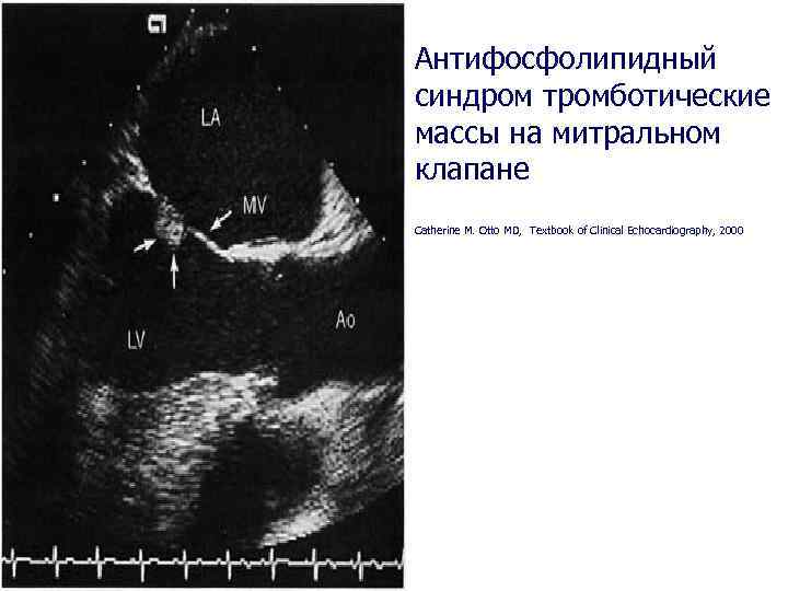 Антифосфолипидный синдром тромботические массы на митральном клапане Catherine M. Otto MD, Textbook of Clinical