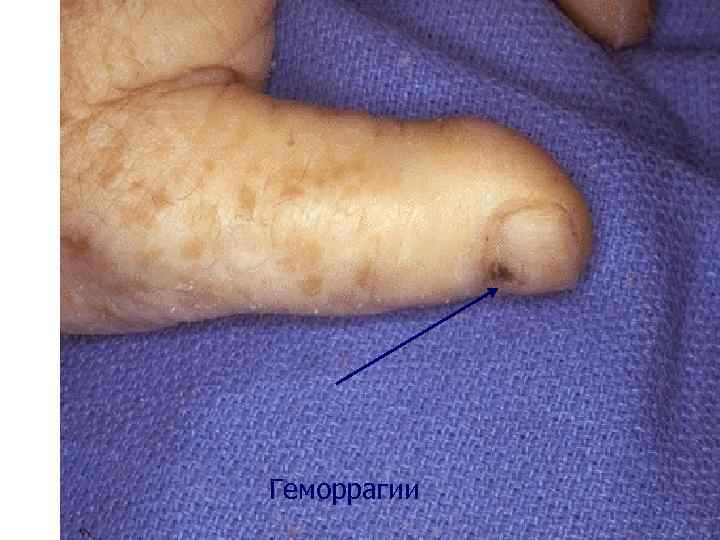  Геморрагии 