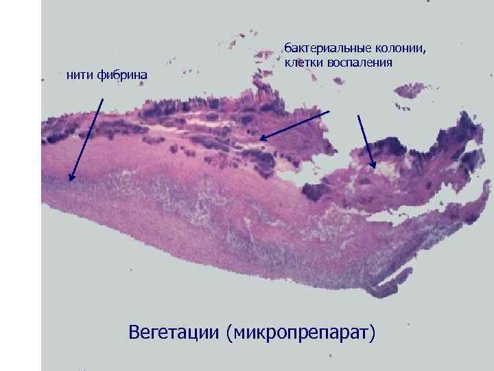 нити фибрина бактериальные колонии, клетки воспаления Вегетации (микропрепарат) 