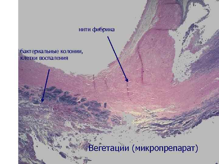 нити фибрина бактериальные колонии, клетки воспаления Вегетации (микропрепарат) 