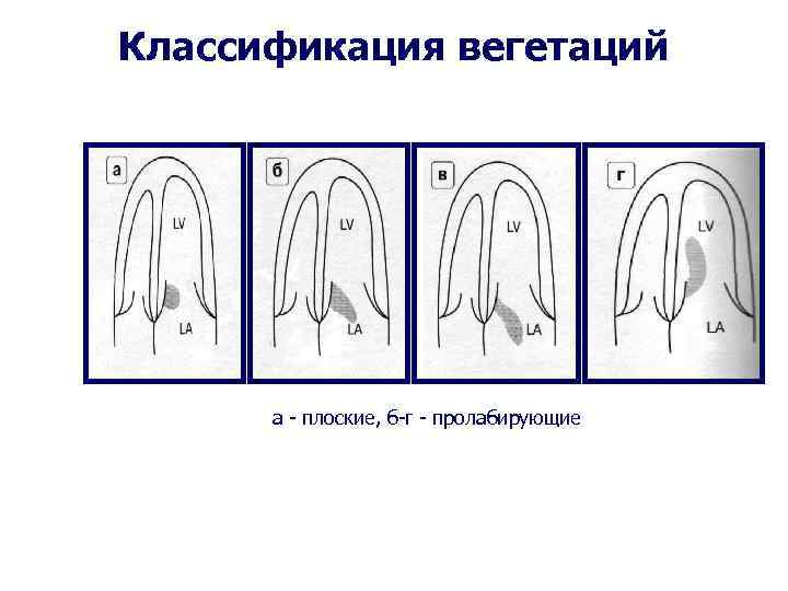 Классификация вегетаций а - плоские, б-г - пролабирующие 