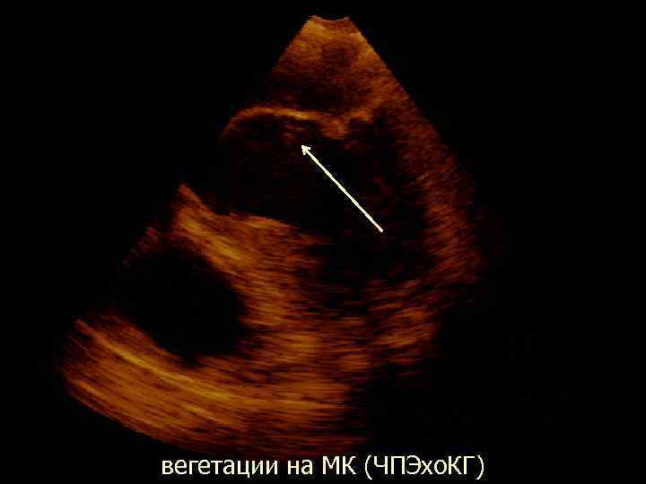  вегетации на МК (ЧПЭхо. КГ) 