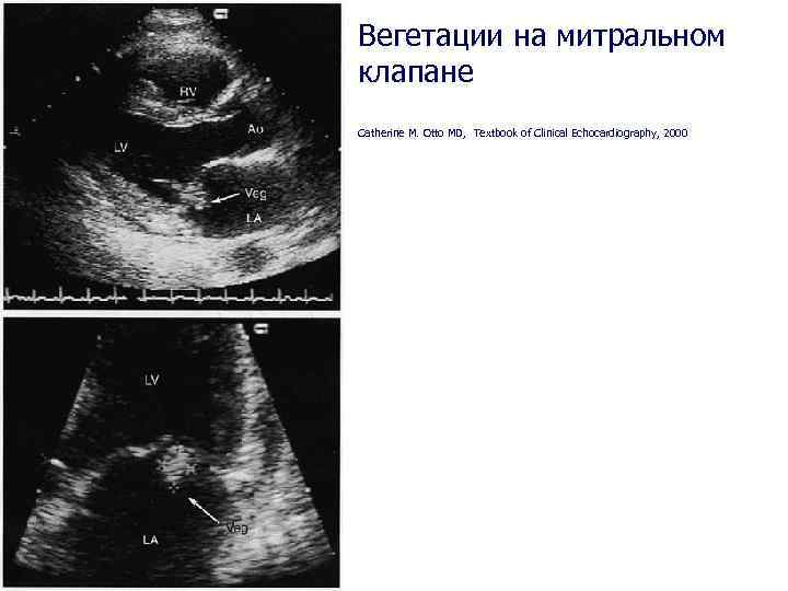 Вегетации на митральном клапане Catherine M. Otto MD, Textbook of Clinical Echocardiography, 2000 