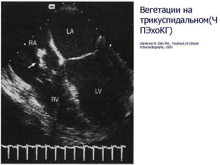 Вегетации на трикуспидальном(Ч ПЭхо. КГ) Catherine M. Otto MD, Textbook of Clinical Echocardiography, 2000