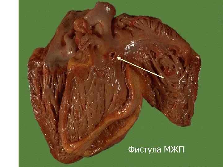  Фистула МЖП 