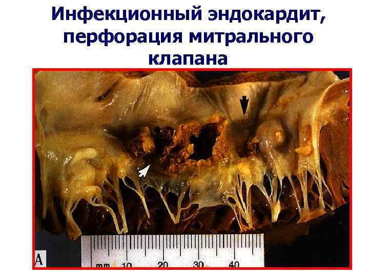 Инфекционный эндокардит, перфорация митрального клапана 