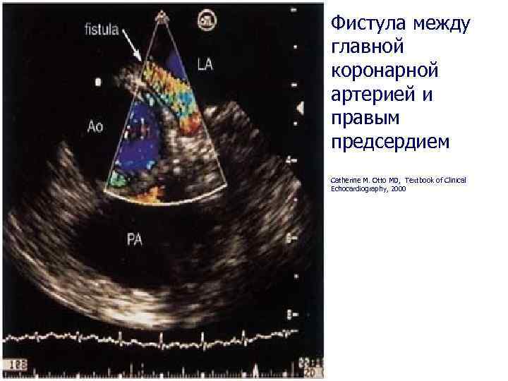 Фистула между главной коронарной артерией и правым предсердием Catherine M. Otto MD, Textbook of