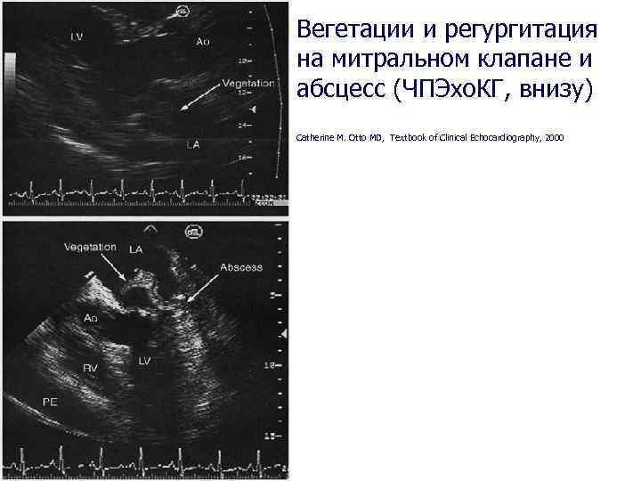 Вегетации и регургитация на митральном клапане и абсцесс (ЧПЭхо. КГ, внизу) Catherine M. Otto