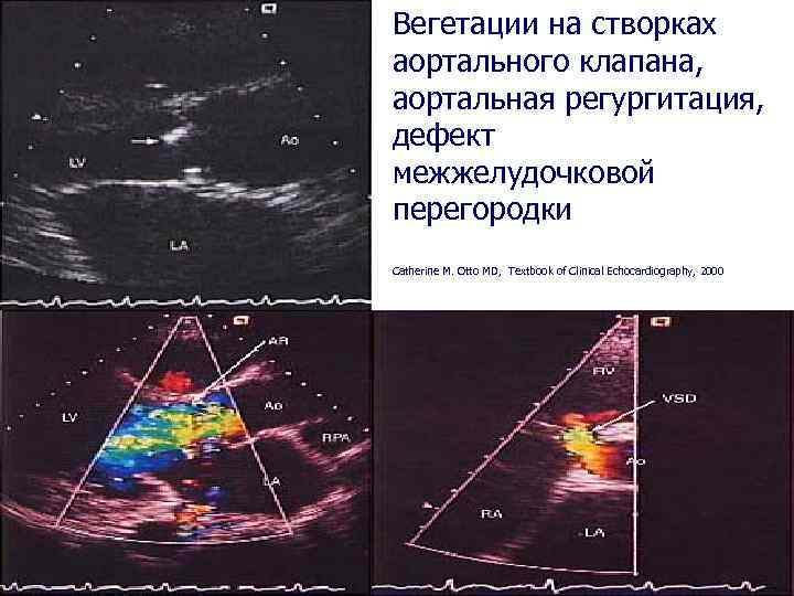 Вегетации на створках аортального клапана, аортальная регургитация, дефект межжелудочковой перегородки Catherine M. Otto MD,