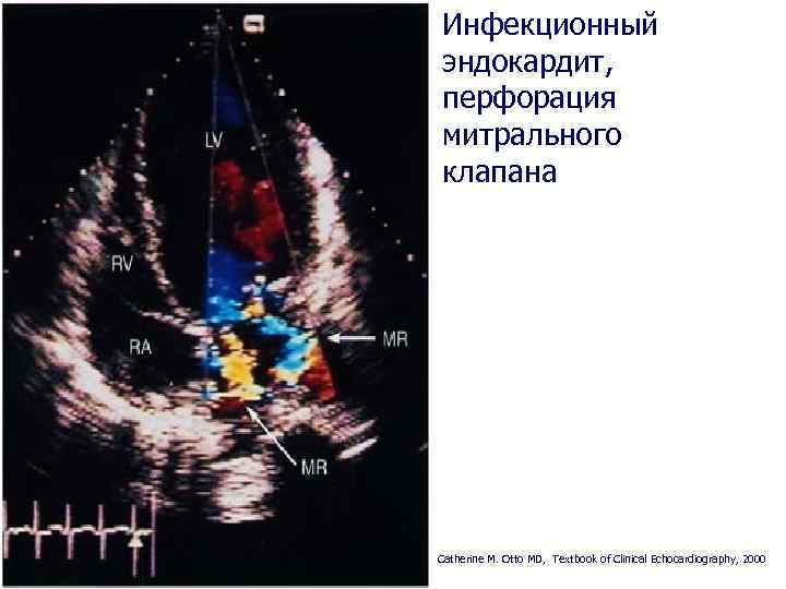 Инфекционный эндокардит, перфорация митрального клапана Catherine M. Otto MD, Textbook of Clinical Echocardiography, 2000