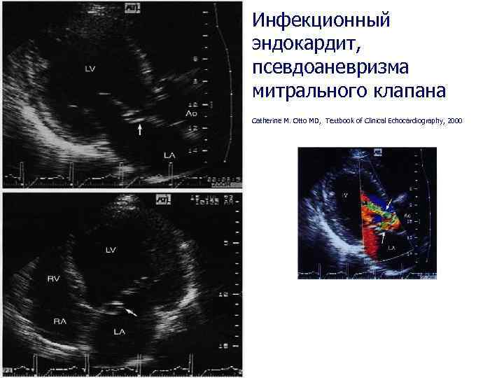 Инфекционный эндокардит, псевдоаневризма митрального клапана Catherine M. Otto MD, Textbook of Clinical Echocardiography, 2000