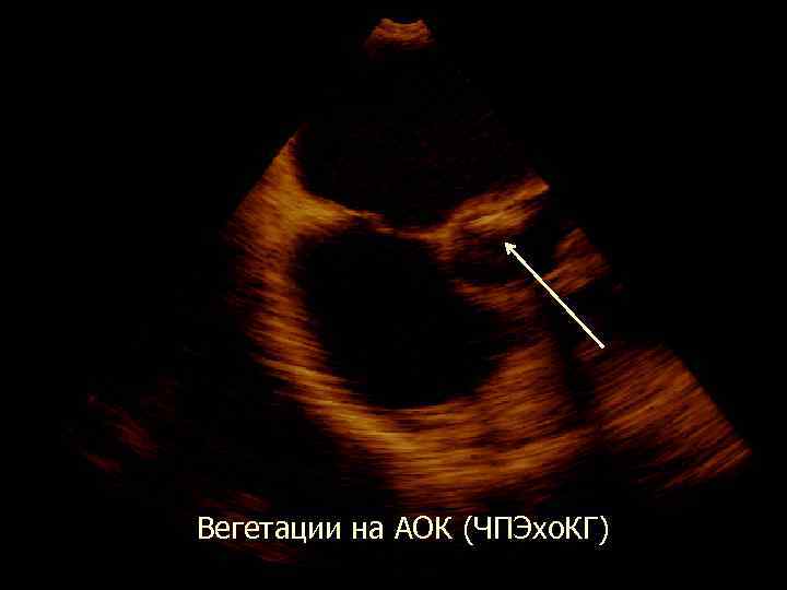  Вегетации на АОК (ЧПЭхо. КГ) 