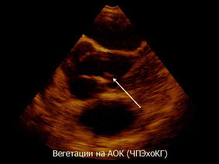  Вегетации на АОК (ЧПЭхо. КГ) 
