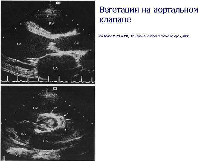 Вегетации на аортальном клапане Catherine M. Otto MD, Textbook of Clinical Echocardiography, 2000 