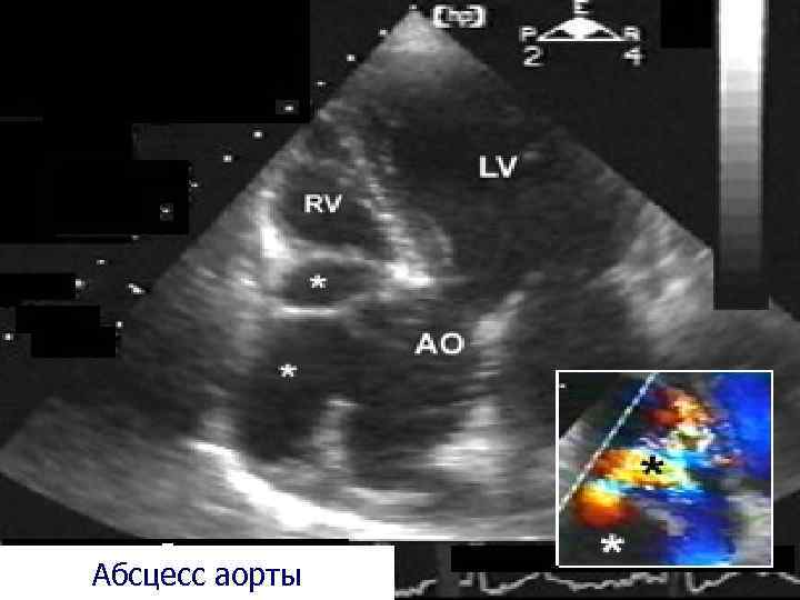 Абсцесс аорты 