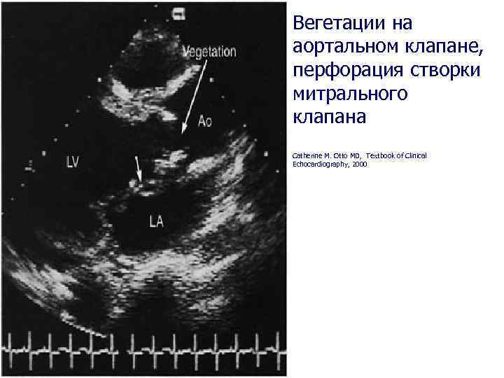 Вегетации на аортальном клапане, перфорация створки митрального клапана Catherine M. Otto MD, Textbook of