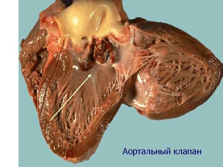  Аортальный клапан 