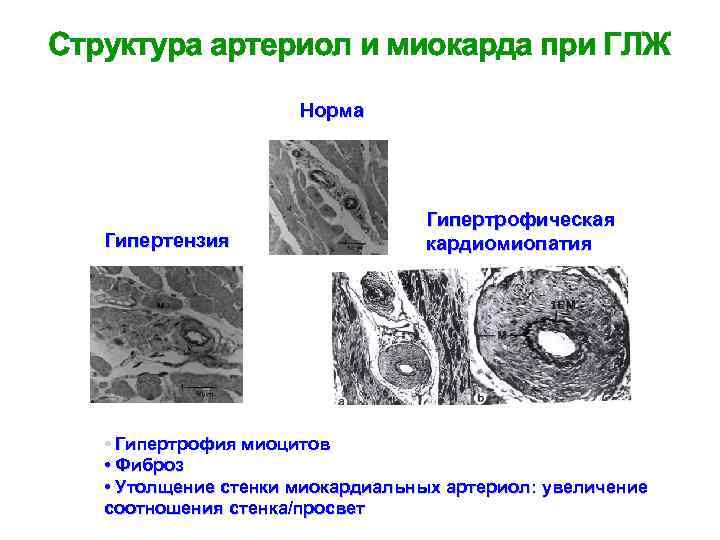 Структура артериол и миокарда при ГЛЖ Норма Гипертензия Гипертрофическая кардиомиопатия • Гипертрофия миоцитов •