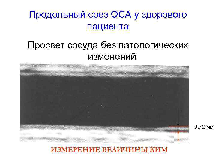 Продольный срез ОСА у здорового пациента Просвет сосуда без патологических изменений 0. 72 мм