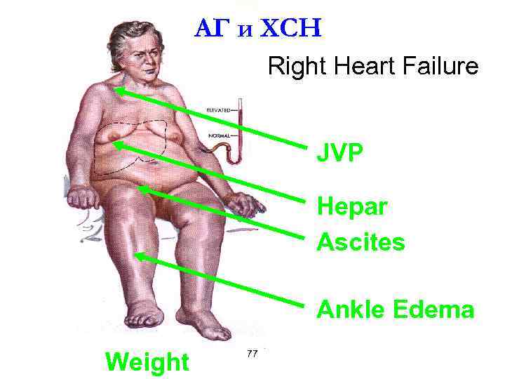 АГ и ХСН Right Heart Failure JVP Hepar Ascites Ankle Edema Weight 77 