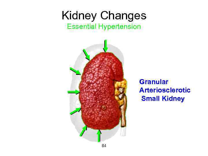 Kidney Changes Essential Hypertension Granular Arteriosclerotic Small Kidney 84 