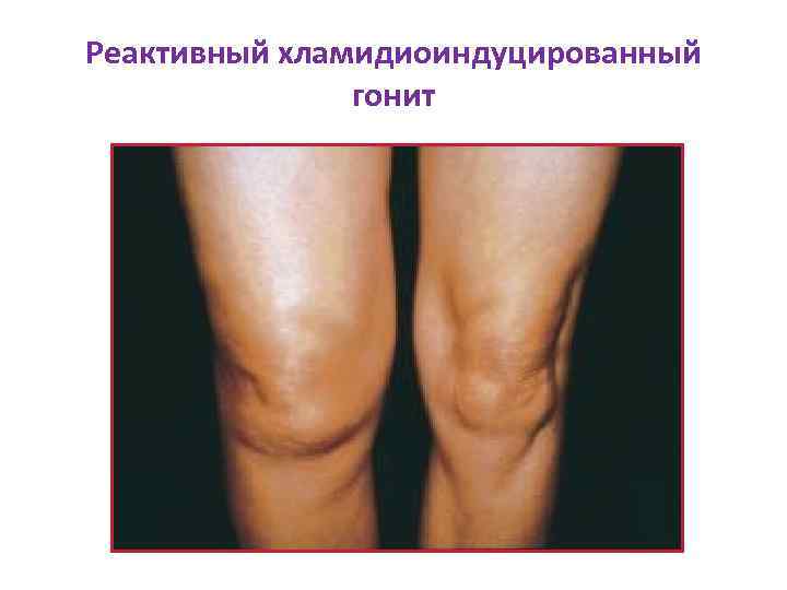 Реактивный хламидиоиндуцированный гонит 