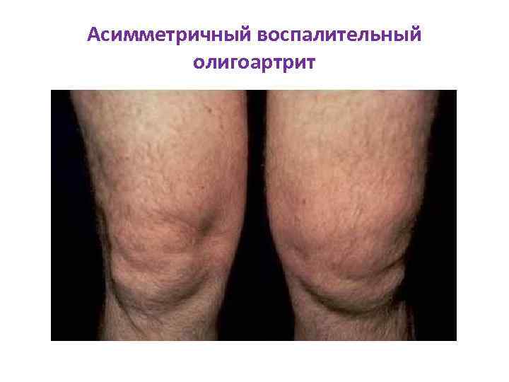 Асимметричный воспалительный олигоартрит 