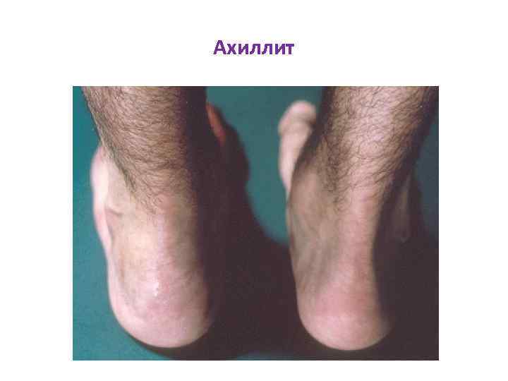 Ахиллит 