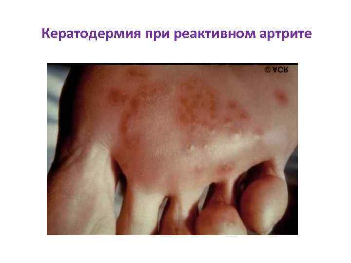 Кератодермия при реактивном артрите 