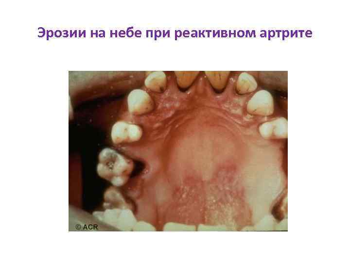 Эрозии на небе при реактивном артрите 