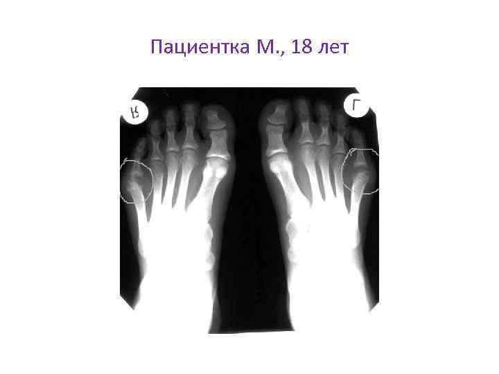 Пациентка М. , 18 лет 