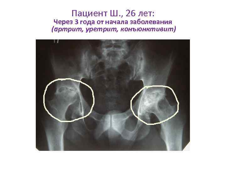 Пациент Ш. , 26 лет: Через 3 года от начала заболевания (артрит, уретрит, конъюнктивит)